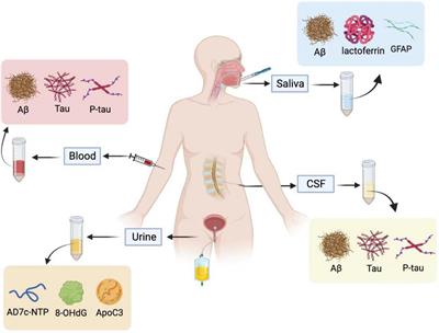Is liquid biopsy mature enough for the diagnosis of Alzheimer’s disease?